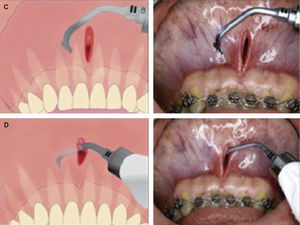 Surgical procedure with electrical micro-saw.6