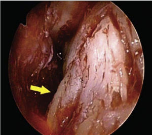 Close-up with endoscope to assess bleeding.6