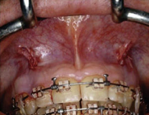 Incision suture.6
