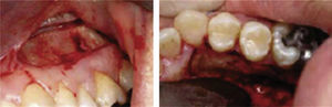 Selective alveolar corticotomy.7.
