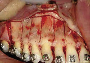 Selective alveolar corticotomy.10.