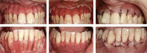 Corticotomy technique (PAOO).11.