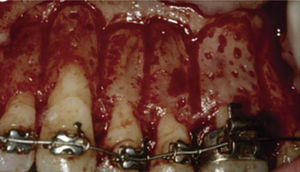 Link of inter-radicular vertical corticotomies with semi-circular cortcotomies at the apical third.3.