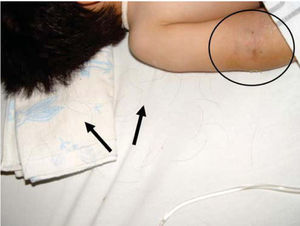 Hair loss and traces of hematoma at different healing stages.
