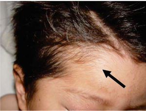 Alopecic area of probably traumatic origin.
