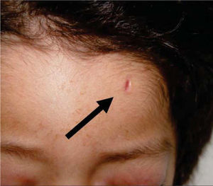 Scar at the left frontal region.