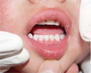 Maximum opening during intra-oral examination with slight deviation to the right.