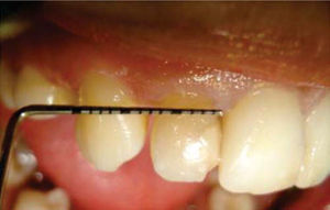 Diastema between teeth 12 and 13.
