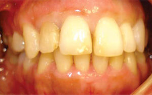Front view, Tooth 12 incisal fracture can be observed.