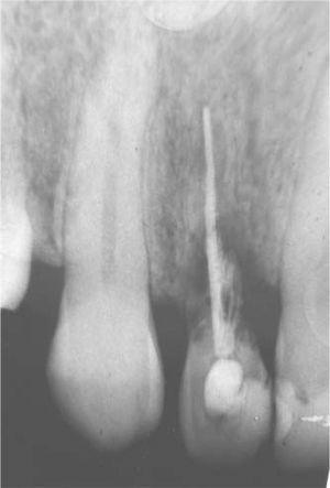 X-ray showing ankylosis and root resorption.