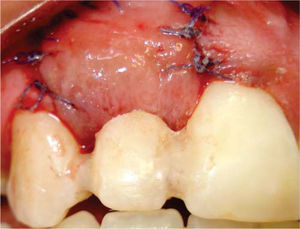 Provisional prosthesis with crown remodeled and splinted to adjacent teeth.