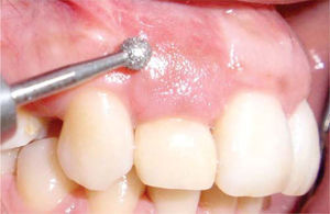 Muco-gingival plastic surgery performed with low speed diamond burr.