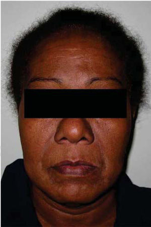 Extra-oral clinical picture. Slight volume increase in the right lower face is observed.