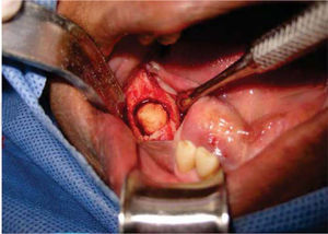 Intra-operative clinical photograph of peripheral ostectomy to achieve excisional biopsy of the lesion.