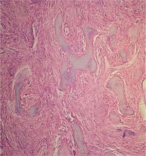 Histopathological study with hematoxylin and eosin of the lesion composed of irregular bone tissue interspersed with fibroblasts and numerous blood vessels circumscribed with endothelium of normal aspect and replete with erythrocytes with areas of dense lymphoplasmocytic inflammatory infiltrate.