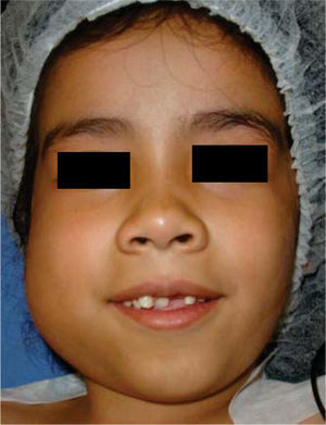 Volume increase in right mandibular body and ramus is observed.