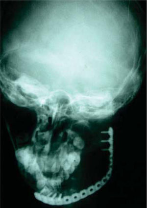 Radiographic view of mandibular reconstructive prosthesis with condyle preservation after ameloblastoma resection.
