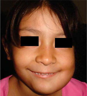 Facial aspect two months after resection of left mandibular ameloblastoma with placement of reconstructive prosthesis.