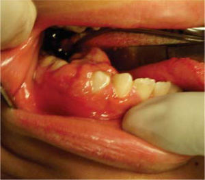 Intra-oral view of right mandibular ameloblastic fibroma.