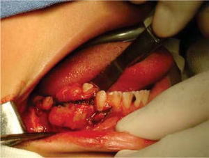 Surgical block excision of mandibular ameloblastic fibroma.
