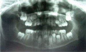 Extensive radio lucid right mandibular area involving condyle and coronoid apophysis.