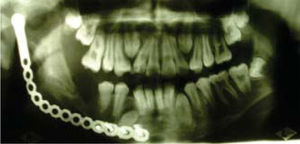Radiographic view exhibiting mandibular bone neo-formation following the contour of titanium reconstruction plate.