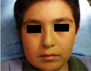 Facial aspect one year after hemimandibulectomy and mandibular reconstruction prosthesis with condyle placement.