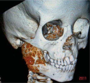 Right mandibular osteoblastoma 3-D tomography.