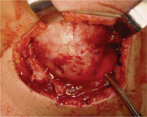 Surgical aspect of right mandibular osteoblastoma resection.
