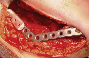 Mandibular prosthesis with condyle after right hemi-mandibulectomy.
