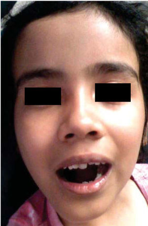 Facial appearance two months after right hemimandibulectomy and placement of reconstruction prosthesis with condyle.