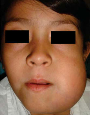 Facial appearance with a five month evolution of right mandibular ameloblastoma.