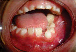 Intra oral view of a five month old evolution mandibular ameloblastoma.