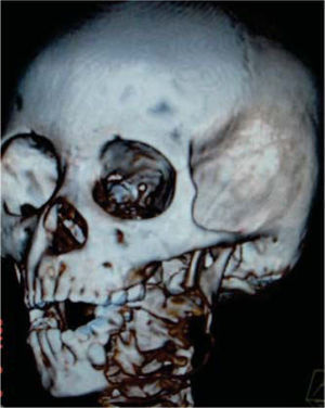 Left mandibular ameloblastoma 3D tomography, with preservation of coronoid apophysis and condyle.