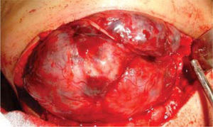 Surgical aspect of right mandibular ameloblastoma with preservation of lower dental nerve.