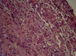 Cemento Bioceramic (96 horas) con células plasmáticas, neutrófilos y macrófagos. Infiltrado inflamatorio moderado (H&E) (40X).