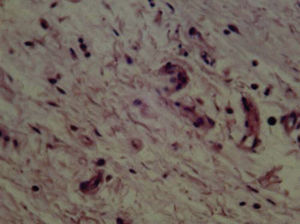 Cemento Bioceramic (21 días) con fibroblastos y presencia de colágeno. Infiltrado inflamatorio leve (H&E) (40X).
