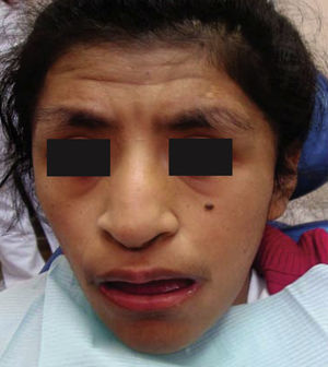 Facial appearance of the patient. Beak shaped nose, strabismus, low-implanted ears.