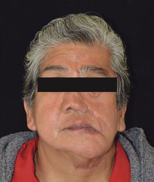 Patient with Goldenhar syndrome.