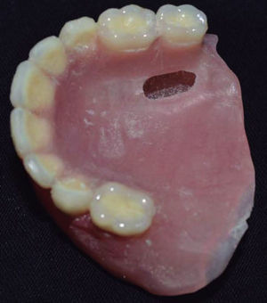 Hollowed-out upper denture.