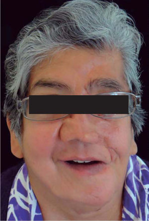 Patient's appearance with dentures in place.