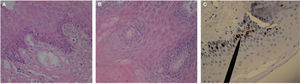 Fotos histológicas COCE con H&E. A) Objetivo de 10x se observa epitelio hiperplásico infiltrado hacia la lámina propia, engrosado. B) Objetivo de 40x se aprecia estrato escamoso de epitelio lingual con foco displásico, en el cual se observan queratinocitos entre mega y microcarióticos, con cromatina de predominio. C) Objetivo de 40x el señalador muestra inmunohistoquímica positiva moderada para Ki-67 en queratinocitos del estrato basal y espinoso, negativo para ciclina D1.