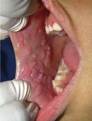 Múltiples pápulas localizadas en mucosa yugal derecha, labial inferior y lengua.