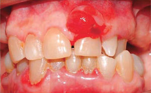 Vista frontal: periodontitis crónica generalizada y agrandamiento gingival a nivel de pieza 2.1.