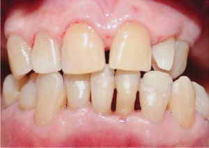 Reevaluación del estado de salud periodontal a los tres meses.