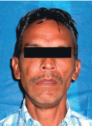 Fotografía clínica frontal donde se observa asimetría facial a expensas de hemicara izquierda con presencia de incompetencia labial.