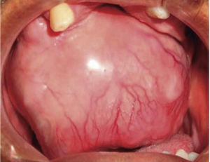 Fotografía clínica intraoral donde se evidencia lesión tumoral de 9 × 9cm de longitud aproximadamente ocupando gran parte de la cavidad bucal.