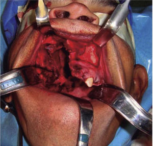 Fotografía clínica intraoral donde se observa lecho quirúrgico posterior a maxilectomía de Brown tipo II B generando una comunicación oro-naso-antral.