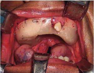 Fotografía clínica intraoperatoria donde se evidencia placa obturadora maxilar en posición mediante suspensión malar con alambre de calibre 0.6mm.