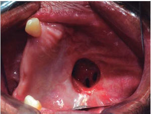 Fotografía clínica intraoral de control postoperatorio de 10 meses donde se observa formación de tejido y fístula oro-nasal en región de paladar.